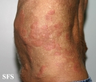 wells' syndrome