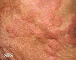 wells' syndrome