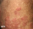 wells' syndrome