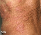 wells' syndrome