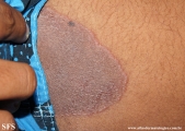 tinea cruris