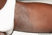 tinea cruris