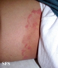 tinea cruris