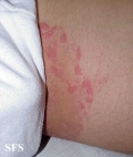 tinea cruris