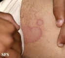 tinea cruris