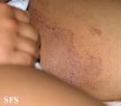 tinea cruris