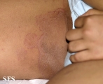 tinea cruris
