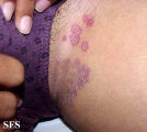 tinea cruris