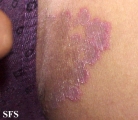 tinea cruris
