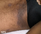 tinea cruris
