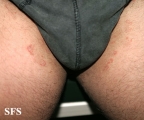 tinea cruris
