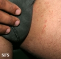 tinea cruris