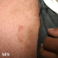 tinea cruris