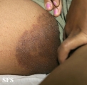 tinea cruris