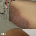 tinea cruris