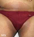 tinea cruris