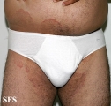 tinea cruris
