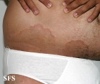 tinea cruris