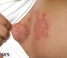 tinea cruris