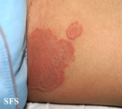 tinea cruris