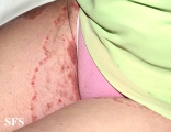 tinea cruris