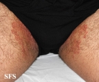 tinea cruris