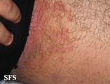 tinea cruris