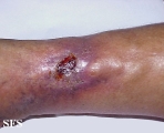 stasis ulcer