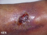 stasis ulcer