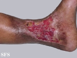 stasis ulcer