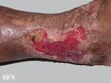 stasis ulcer
