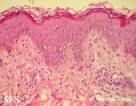 eosinophilic annular erythema
