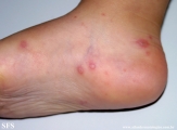 hand-food-and-mouth disease