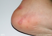 hand-food-and-mouth disease