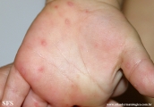hand-food-and-mouth disease