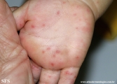 hand-food-and-mouth disease