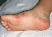 hand-food-and-mouth disease