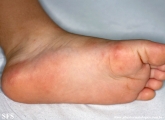 hand-food-and-mouth disease
