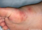 hand-food-and-mouth disease
