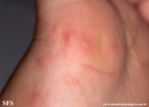 hand-food-and-mouth disease