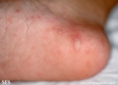 hand-food-and-mouth disease