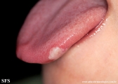 hand-food-and-mouth disease