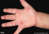 hand-food-and-mouth disease
