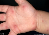 hand-food-and-mouth disease