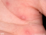 hand-food-and-mouth disease