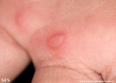 hand-food-and-mouth disease