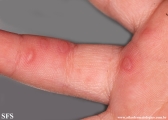 hand-food-and-mouth disease