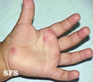 hand-food-and-mouth disease