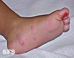 hand-food-and-mouth disease