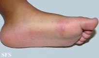 hand-food-and-mouth disease